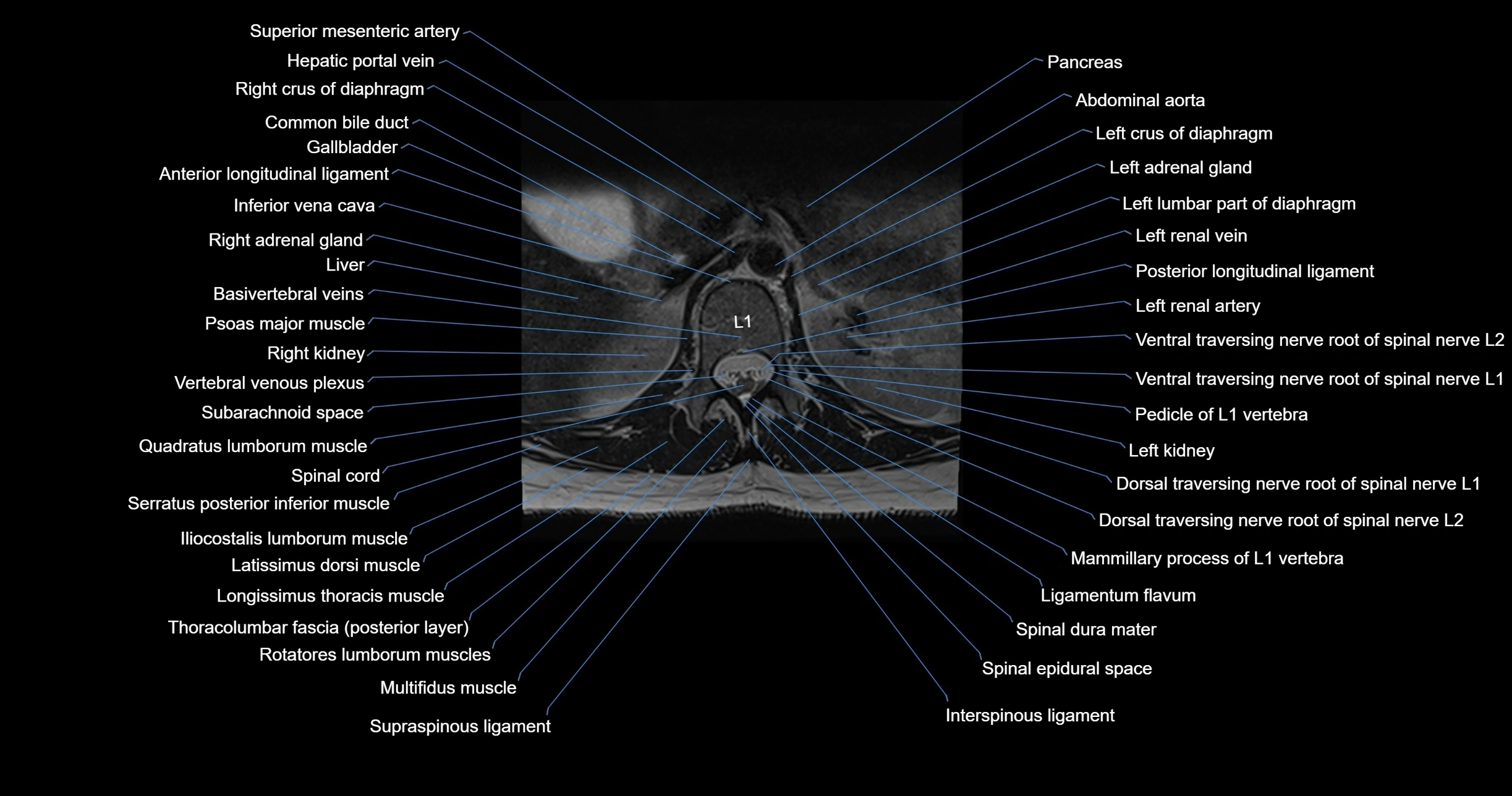 MRI lumbar spine axial cross sectional anatomy 3T radiology  image-img-00001-00007.webp